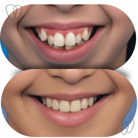 AD04